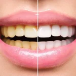 Biaya Bleaching Gigi di Puskesmas, Fakta, Alternatif, dan Tips Lengkap Biaya Bleaching Gigi di Puskesmas, Fakta, Alternatif, dan Tips Lengkap - Tuwaga