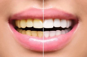 biaya bleaching gigi di puskesmas tuwaga